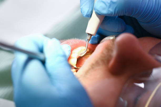 Best Emergency Dental Filling Replacement  in Decordova, TX